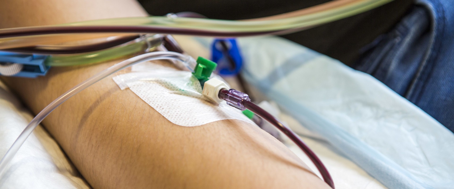 Primer plasmaféresis terapéutica pediátrica en Entre Ríos realizada con un separador celular